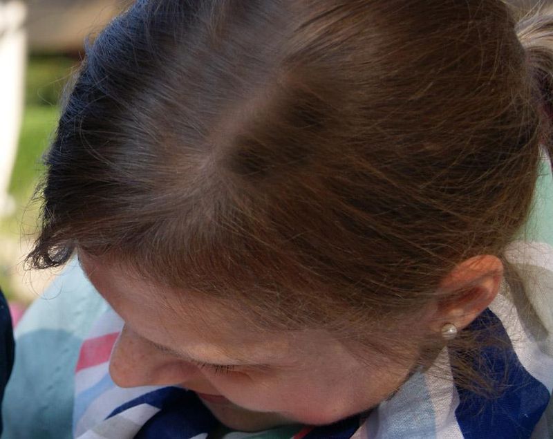 Haarausfall ist nicht nur unter Männern verbreitet - er betrifft auch viele Frauen