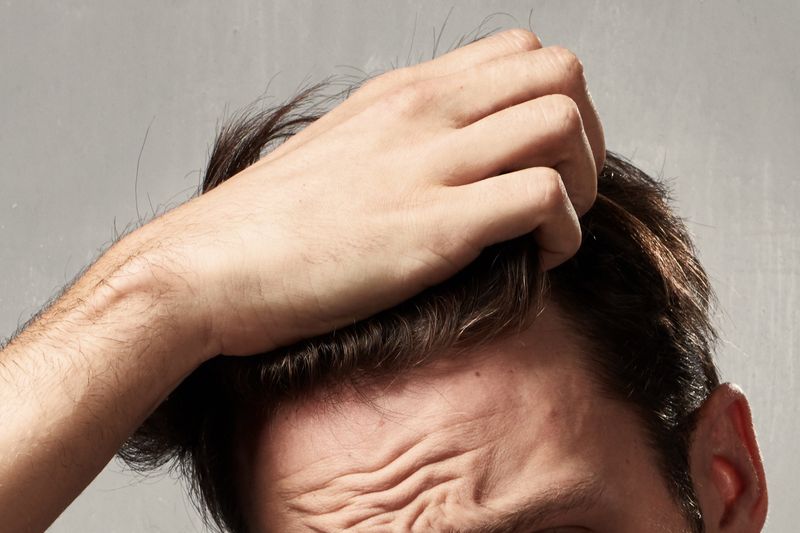 Das Kopfhautproblem bei Männern