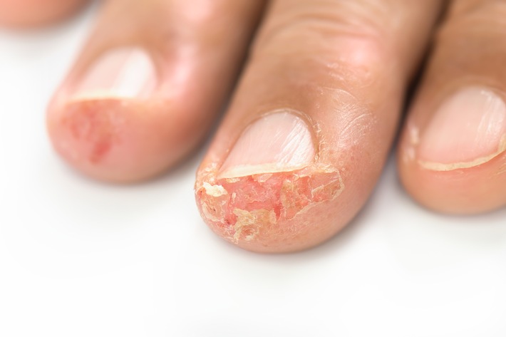 Aufgeplatzte Fingerkuppen über Nacht geschlossen