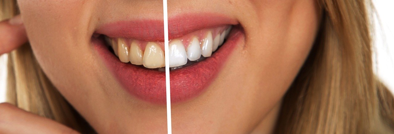 Perfect white teeth Jan D. Heiringhoff Seadent Palma MalTorca 