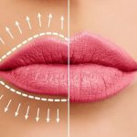 Wie gelingt eine natürliche Lippenvergrößerung?