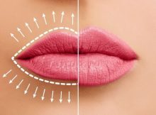 Lippenvergrößerung und Behandlung von Lippenfältchen