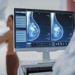 Neue Hoffnung: KI-basierter Test zur Diagnose von Brustkrebs
