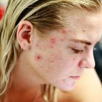 Akne – Ein bekanntes Hautpoblem und was man wirksam dagegen tun kann